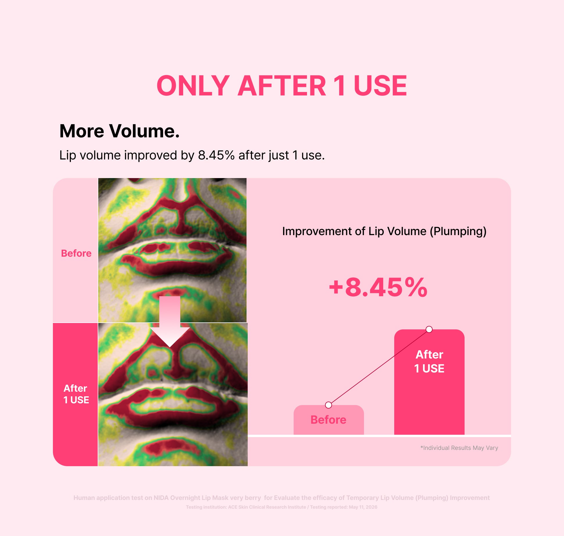 Farbkodierte Aufnahmen des Lippenvolumens vor und nach 1 Anwendung